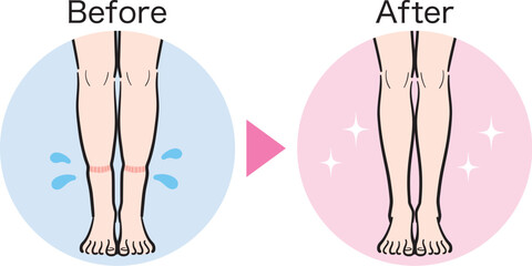 脚の軽度むくみ（靴下跡）のビフォーアフター