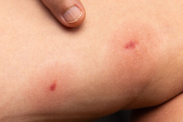 Black fly bite marks on the woman leg.