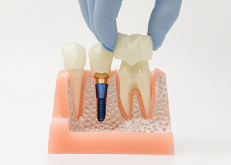 Placing dental crown on implant model in jaw © Maximusdn