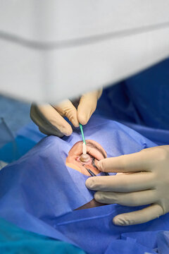 Laser vision correction &ndash; close-up of the patient's eye.