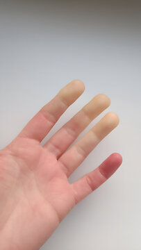 Raynaud's phenomenon on fingers. Close-up of hand with white, numb fingers due to vascular spasms and poor circulation. Medical concept.