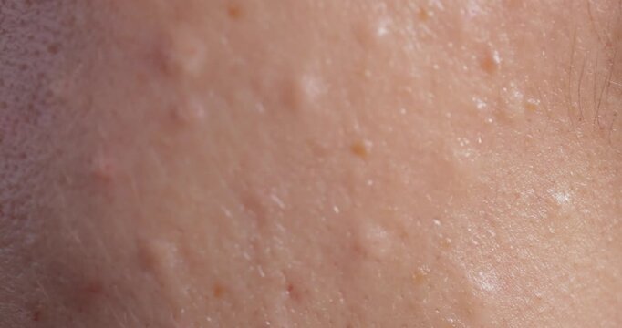 Injectable cosmetology. Facial biorevitalization procedure using a hyaluronic acid-based product. Papules on female face . close-up