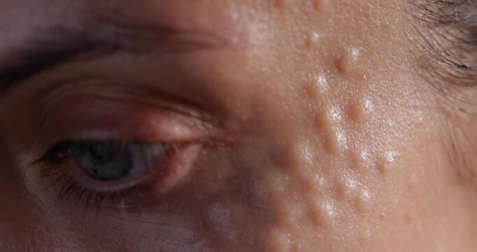 Injectable cosmetology. Facial biorevitalization procedure using a hyaluronic acid-based product. Papules on female face after biorevitalization.