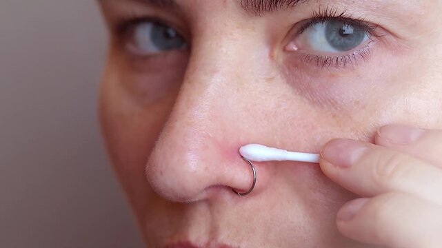 An inflamed nose piercing. A woman swabbing the piercing site with chlorhexidine on a cotton swab. Post-piercing care. Close up footage