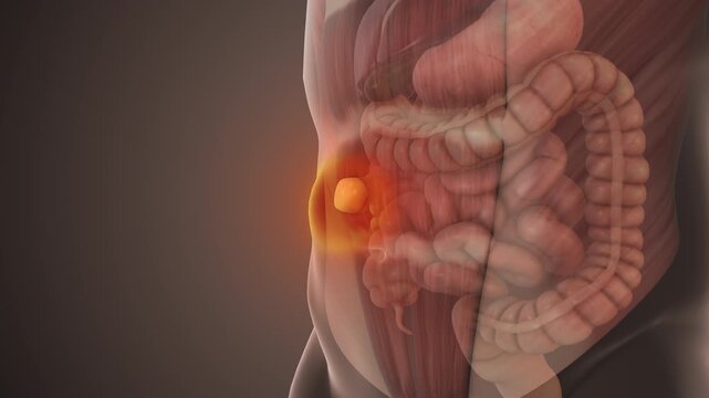 Epigastric Hernia Bulge in Abdominal Wall