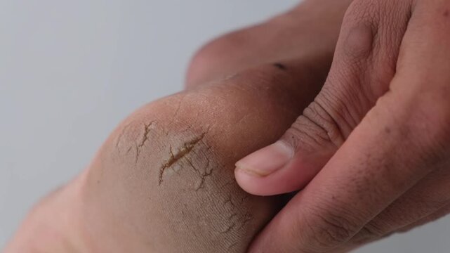 Close-up of a person holding a dry and cracked heel needing skin care treatment
