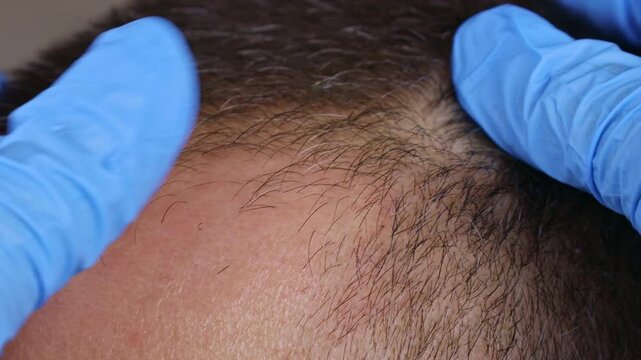 Doctor hands touching and parting man hair revealing hair loss or thinning hair close up