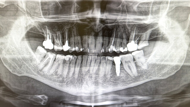 X-ray image of a dental arch, with fillings and some teeth with dental implants and root canal treatment. Bras&iacute;lia, Brazil, 2025