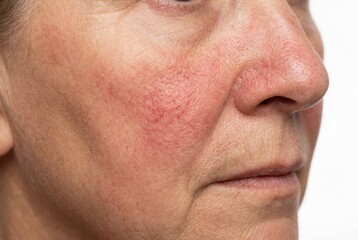Naklejka premium High-key clinical macro close-up of an elderly woman's facial cheek and nose area showing visible rosacea with diffuse redness and small telangiectasia, captured with soft lighting on a white