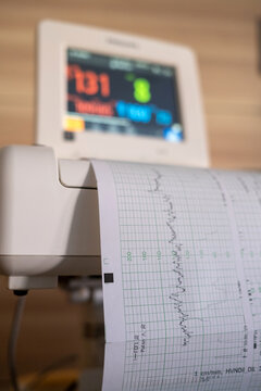 Fetal Monitor Printout Showing Heartbeat Readings In Hospital