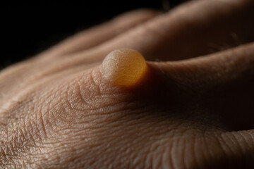 Fototapeta premium Close Up of Burn Blister on Male Hand Knuckle Black Background