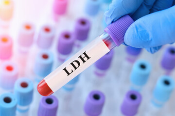 Obraz premium Doctor holding blood sample tube with LDH test in modern medical laboratory, biochemical blood analysis for diagnostics of tissue damage, cell breakdown and metabolic disorders in healthcare