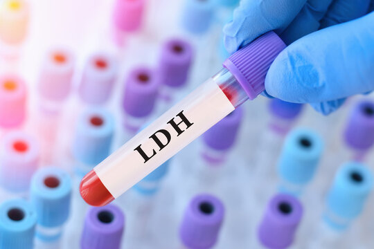 Doctor holding blood sample tube with LDH test in modern medical laboratory, biochemical blood analysis for diagnostics of tissue damage, cell breakdown and metabolic disorders in healthcare