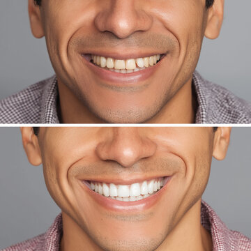Before And After Smile Transformation Of A Young Man Showing Teeth Whitening Dental Results
