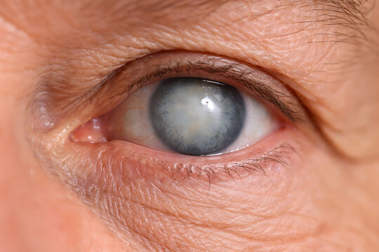 Close Up Eye with Clouded Lens Cataract Detail Photo for Ophthalmology Diagnosis Clinical Imaging and Patient Education
