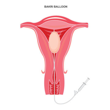 The Bakri balloon procedure is a lifesaving method to control postpartum hemorrhage by inserting a balloon into the uterus to apply pressure and stop bleeding.Medical illustration.