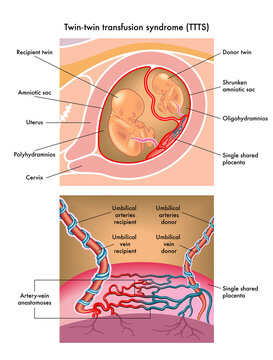 Medical illustration of Twin-twin trasnfusion syndrome (TTTS)