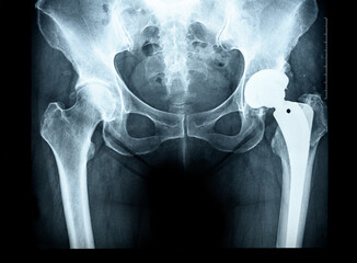 X-ray of the pelvis Endoprosthesis, the socket of the hip joint rheumatic diseases and Rheumatoid...