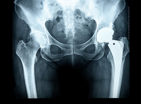 X-ray of the pelvis Endoprosthesis, the socket of the hip joint rheumatic diseases and Rheumatoid Arthritis