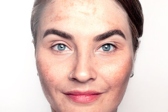 Pigment spots on a woman's face. Wrinkles, melasma, Dark spots, freckles, dry skin on face middle age woman.