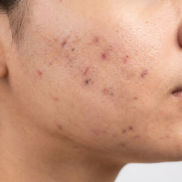 Young Asian woman with acne marks on lower cheek area  