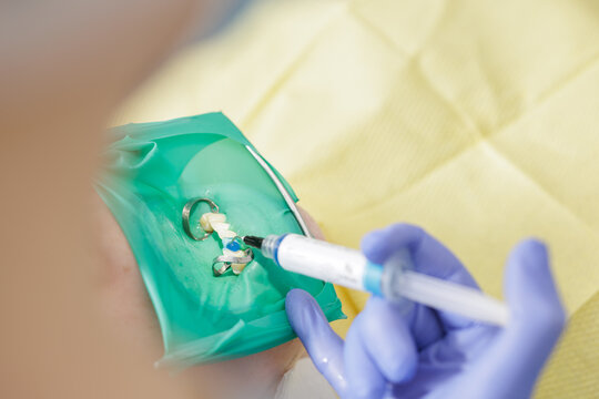 Dentist applying composite resin under rubber dam isolation