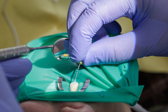 Dentist performing root canal treatment using rubber dam isolation