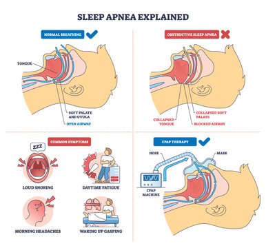 Sleep apnea explained, side-by-side airway cross-sections show normal, obstructed, and CPAP-treated breathing, key objects, airway, tongue, CPAP mask. Diagram