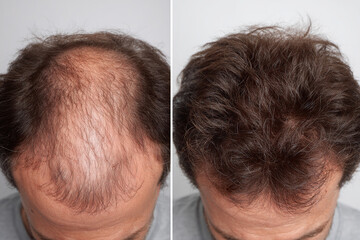 Man experiencing hair loss and hair restoration results