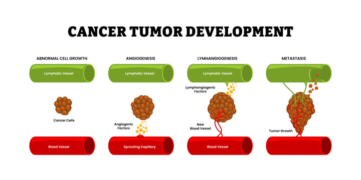 Stages of cancer tumor development stages process. Cancer cell invasion. Tumor growth. From abnormal cell growth, angiogenesis, lymphangiogenesis, metastasis. Blood vessel and lymphatic vessel
