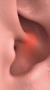 Medical CGI Visualization of Posterior Laryngeal Irritation and Inflammation with Redness and Swelling Detailed Anatomy for Education and Awareness