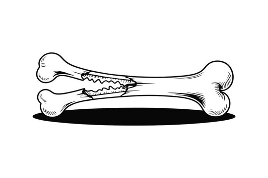 An open fracture bone illustration with a compound fracture