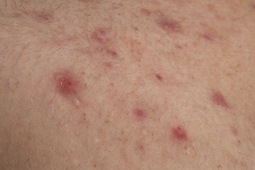 Fototapeta premium Acne and pimple,on skin closeup. Acne macro, pimple on skin. Pimple texture in pores. Pimple macro for dermatology.