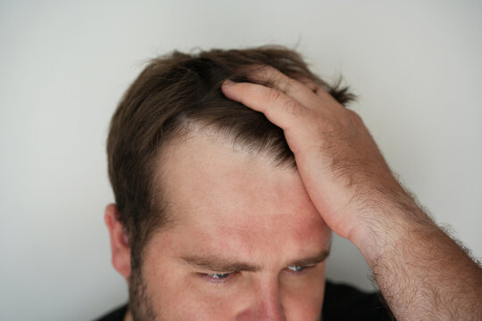 Adult man touching his head showing receding hairline and thinning hair at the temples. Close-up portrait highlighting early male pattern baldness and hair loss concern.