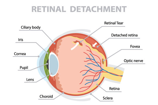 Human eye anatomy showcasing retinal detachment. Flat vector poster on white background.