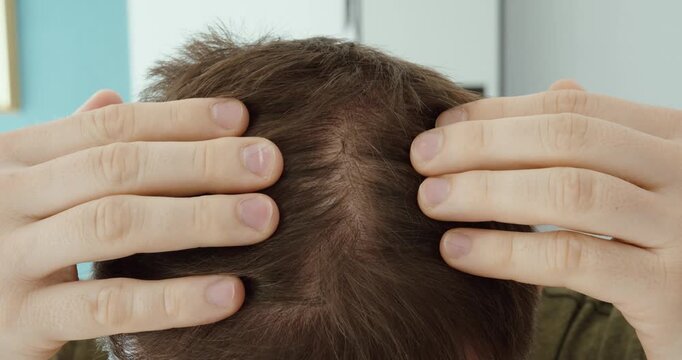 Close-up of a man parting his hair to inspect the scalp, highlighting concerns about dandruff, lice infestation, itching, and personal hygiene at home.