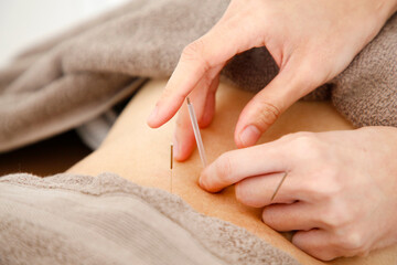 背中への鍼治療を受ける患者と鍼灸師の手元 東洋医学による痛みの緩和とヘルスケア © Buppy