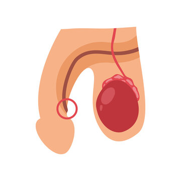 Simplified diagram illustrates common male reproductive anatomical issues including a scrotal mass and urethral opening observation