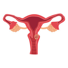 Fototapeta premium Illustration depicts the female reproductive system featuring a uterine growth within the lower cavity.