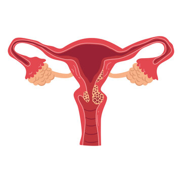 Simplified illustration displays internal reproductive organs affected by growths within the canal