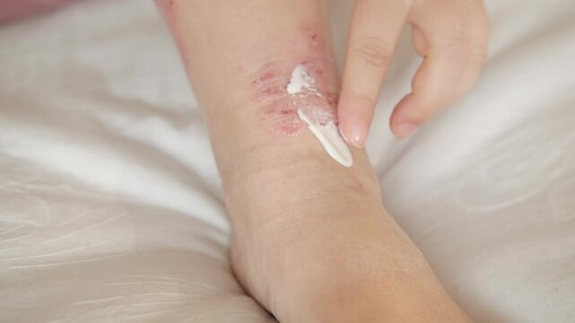 healing wound from on lower leg with scars adult female patient, redness, sores on limb, scarring of skin, concept of medical care, health care, human tissue regeneration, scald on women feet