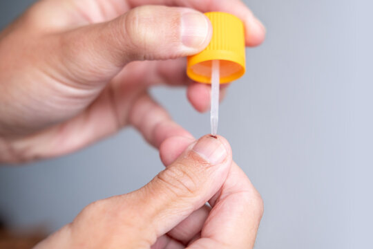 closeup hand treating small cut, wart or skin lesion on fingertip with liquid medicine, skin lesion healing, skin recovery, dermatologic care, periungual verruca