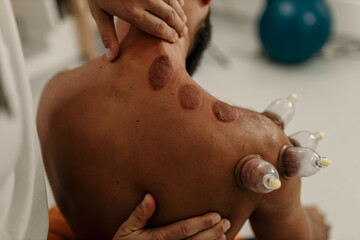 Client receiving cupping therapy treatment on back shoulder
