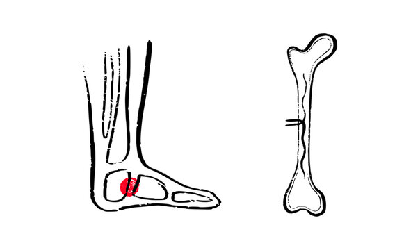 Osteomyelitis disease sketch