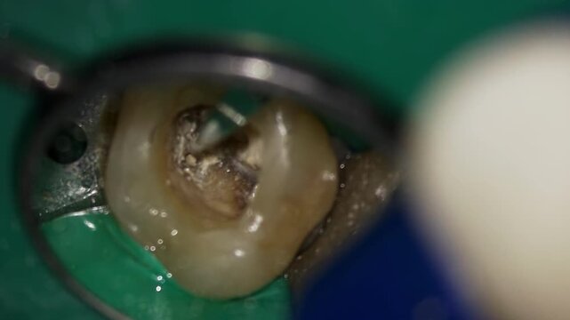 Closeup of root canal work. Detailed imagery showing endodontic tool insertion in progress. Comprehensive microscopic perspective of root canal treatment in detailed dental imagery