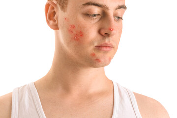 Fototapeta premium Young man with severe acne, inflamed pimples and pustules on face, cheek and chin isolated on white background, skincare problem and dermatology concept