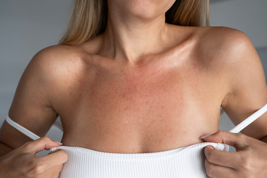 Female chest with sunburn redness and allergic rash after sun exposure. Visible bikini tan lines and irritated skin on d&eacute;collet&eacute;, concept of sun damage, UV exposure and sensitive skin reaction
