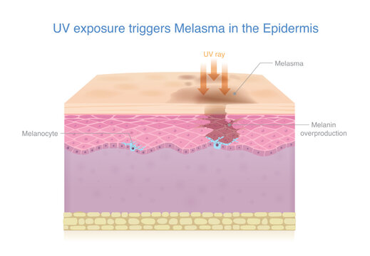 UV rays affect to dark spots on the skin. Accumulation of pigment make melasma, dark spots, and hyperpigmentation on the skin surface. UV triggering melanocytes to produce excess melanin.