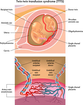 Medical illustration of Twin-twin transfusion syndrome (TTTS)