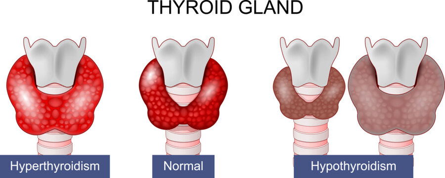 Thyroid gland. Hypothyroidism and Hyperthyroidism